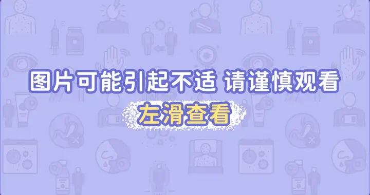 不致命，但巨癢巨難纏！夏天身上長出這種“小水泡”，一定要注意