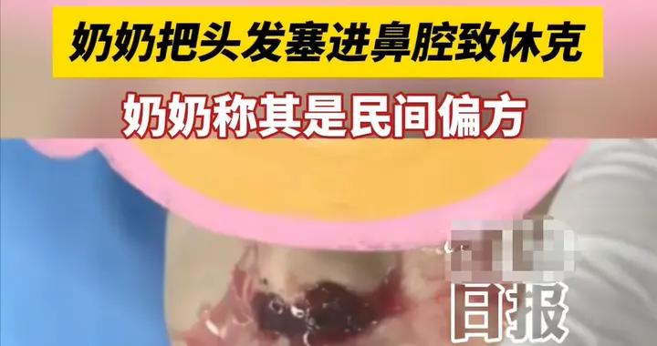 三歲孩子流鼻血用紙巾塞險送命，醫生怒斥奶奶：這兩招才正確