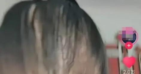脫髮 8 年多，頭頂都禿了，用姜水洗頭後竟然不掉髮了？