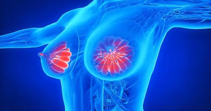 醫生：乳腺結節和乳腺癌沒你想得那麼緊密,別再瞎猜