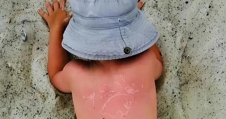 三歲前孩子被曬傷成年後患癌風險翻一倍！夏天給娃防曬很重要