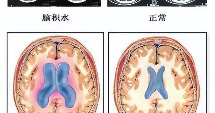 【超實用·家長版】一分鐘看懂“寶寶腦積水”