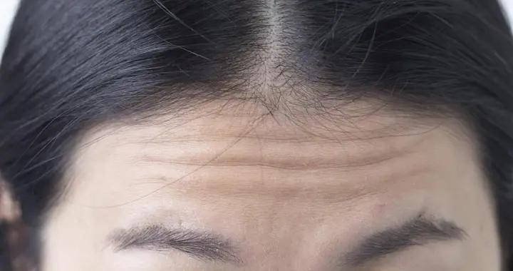 抬頭紋太顯眼？別擔心，多種去除方式任你選，總有一款適合你