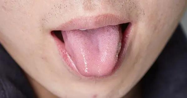 發現齒痕舌別擔心，分清情況，該自愈的跑不了