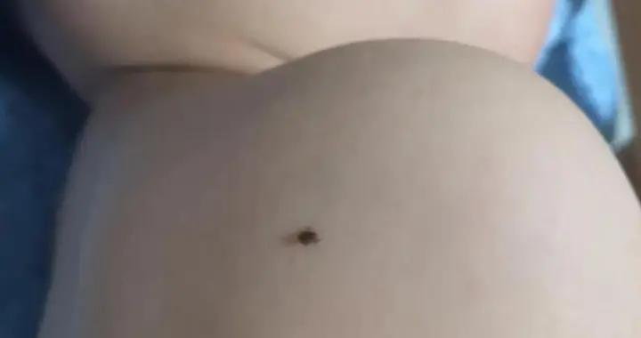 蜱蟲鑽進孩子胳膊，媽媽“兩阻止”救了娃，醫生：科學四步可救命