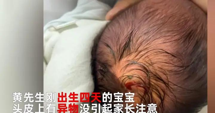 蜱蟲鑽進孩子後背，媽媽「兩阻止」救了娃，醫生：科學四步可救命