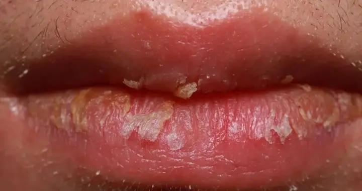 嘴脣總是乾裂、起皮,可能不是“水喝少了”,而是得了這種病!