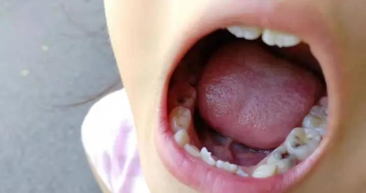 6歲孩子從不喫糖卻滿嘴爛牙，牙科醫生：兩種營養食物喫錯了