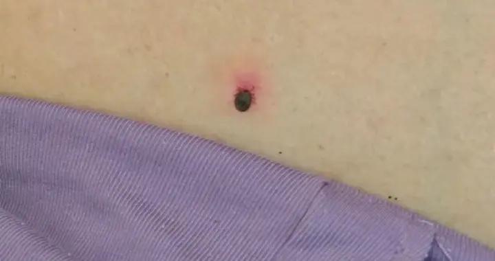 蜱蟲鑽進孩子屁股，爸爸“兩拒絕”救了娃，醫生：牢記五步保命法