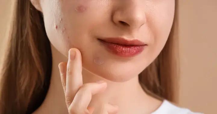 皮膚病要忌口，要清淡飲食？