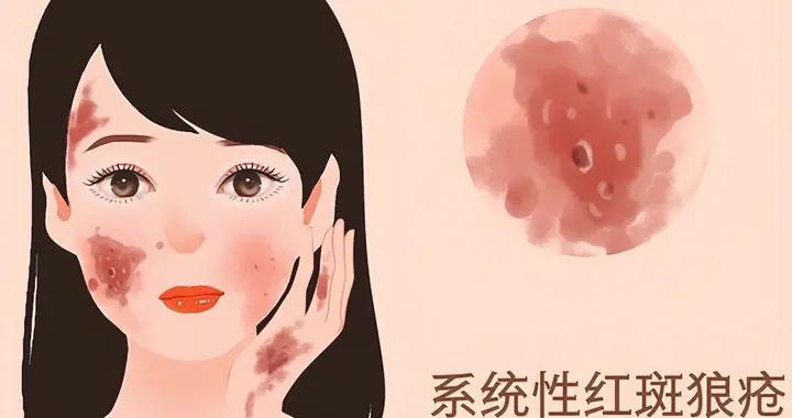 瞭解紅斑狼瘡早期症狀:皮膚、血液等方面的異常要警惕