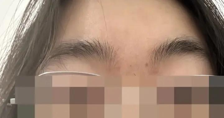 斑疹、丘疹、皰疹、結痂，我身上這“四世同堂”還缺一世