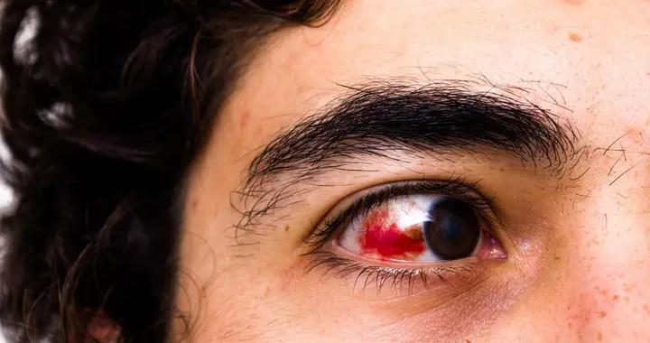 睡醒發現眼睛有血塊？是熬夜導致的嗎？還有這些原因可能被你忽略
