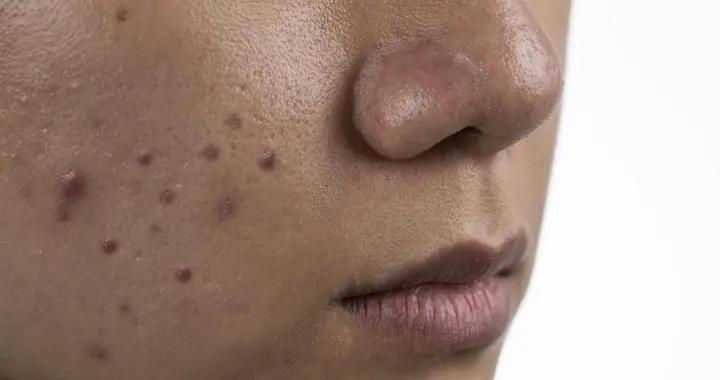 痘印消失要多久？分類型看週期，科學護理讓紅痘印淡化