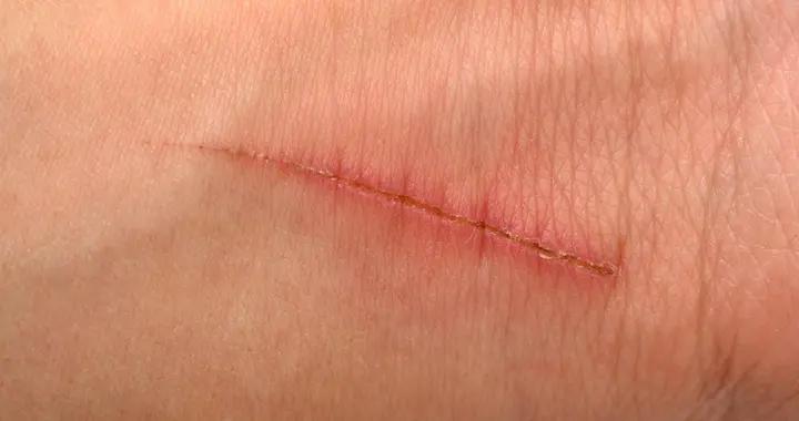 臉被指甲劃傷怎麼處理不會留疤？科學護理指南來了