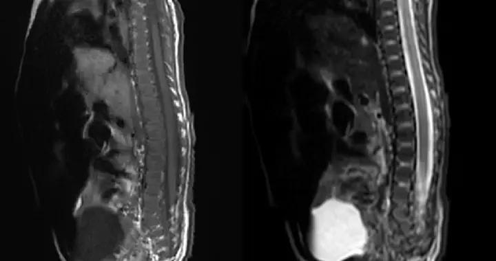 脊柱裂專欄-第39期（ 嬰兒之脊髓栓系+椎管內脂肪+脊髓脊膜膨出）