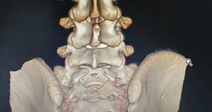 脊柱裂專欄-第40期（小孩頻繁尿牀之脊柱裂 ）