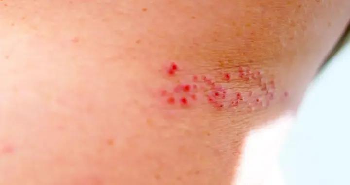 蛇纏腰要火爆頭尾，免得竄遠？