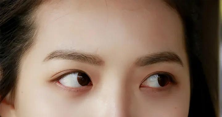 上眼皮腫持續不消退？警惕這些情況要就醫，附日常消腫與預防攻略