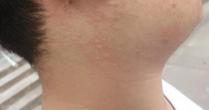 晚上身上起疙瘩還癢？這些原因要清楚