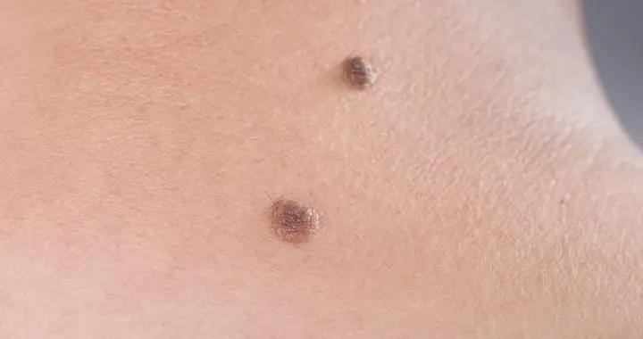 黑痣變大說明在惡變？