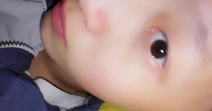 腫眼泡怎麼判斷？手把手教你區分，別再和眼腫搞混了