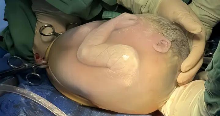 孕媽生下“果凍寶寶”，寶爸當場看懵，醫生卻笑着道喜，咋回事？