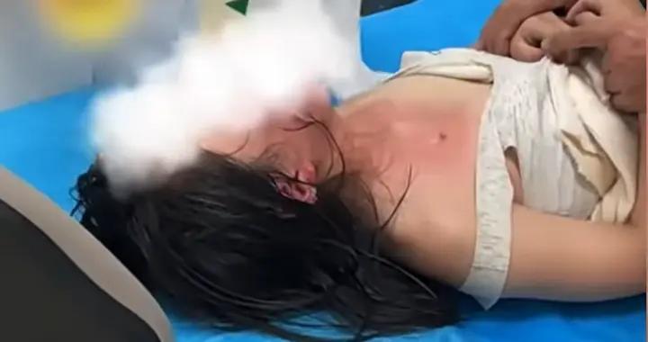 女孩煮麪被燙傷，爸爸火速就醫害娃毀容，醫生一句話讓爸崩潰