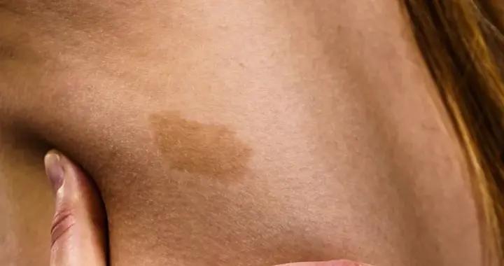 胎記就是出生就有的印記？