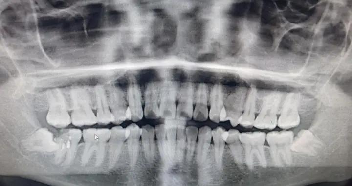智齒橫着長一定要拔嗎？醫生：這2種情況可觀察，其餘建議拔