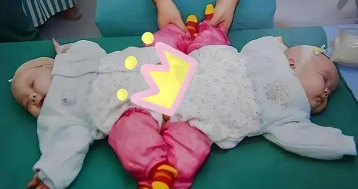 女子產檢6次全正常，生下連體雙胞胎，成功分離後怎樣了？