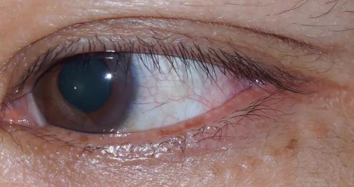 發現眼白有黃斑嚇一跳？到底咋回事啊？這幾種可能，看完心裏有底