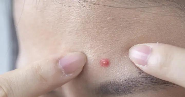 紅腫硬痘痘反覆長？揪出3大成因，從根源遠離“痘”煩惱