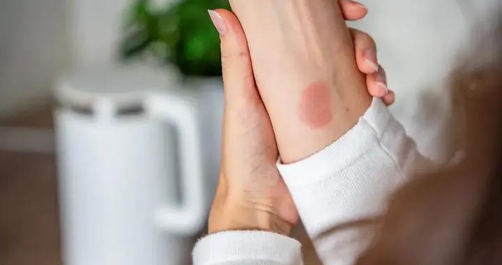 燙傷之後，要用燙傷膏？