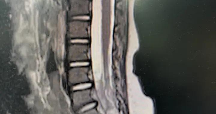 脊柱裂專欄-第42期