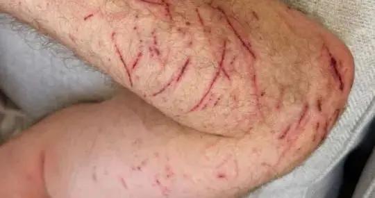 希勒騎車時因路面坑洞摔傷，手部和腿部有多處擦傷