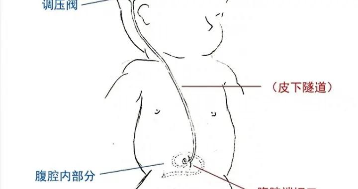 腦積水專欄-第48期（什麼是腦積水、怎麼治療相關科普）