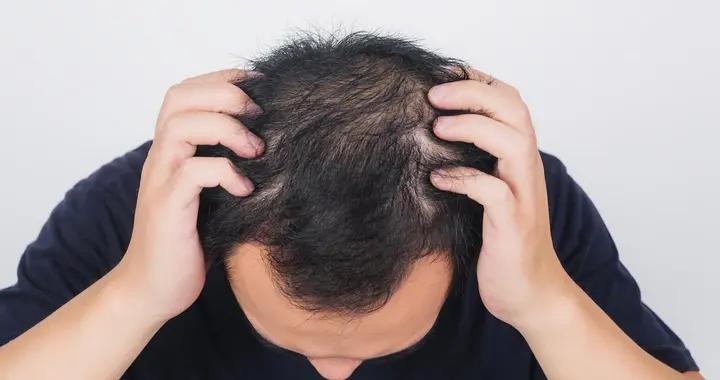 “熬最晚的夜，掉最多的發”：熬夜脫髮恢復指南，照做頭髮慢慢長