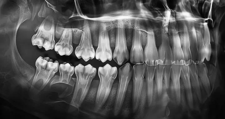 17歲後要留意！智齒生長有規律，出現這些情況建議及時看醫生