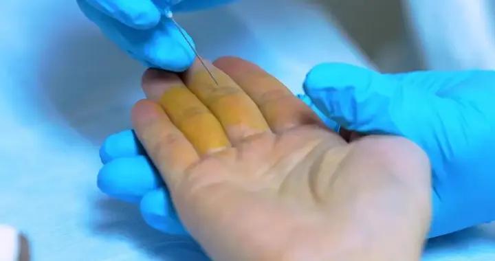 神奇中醫療法丨篤篤手指，治療小兒疳積、厭食、百日咳