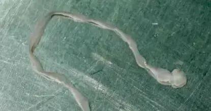 廣東一61歲女子突發抽搐、嘴角歪斜，腦內抽出8釐米活蟲！醫生緊急提醒：別再這樣喫了