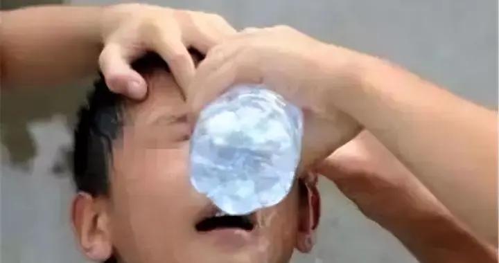 生石灰乾燥劑入眼，媽媽“沖水半小時”救了娃，醫生：不用治了