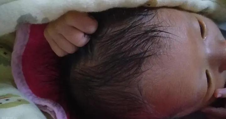 寶寶頭上“頭皮屑”反覆？先辨類型再護理，醫生教你正確做法