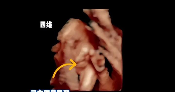B超裏胎寶咧嘴笑，爸爸笑稱“寶寶真可愛”，醫生：建議流產