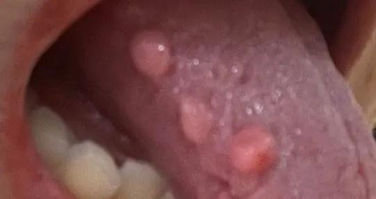 舌頭上長疙瘩卻要去婦科就診，這麼小衆的事被我碰上了