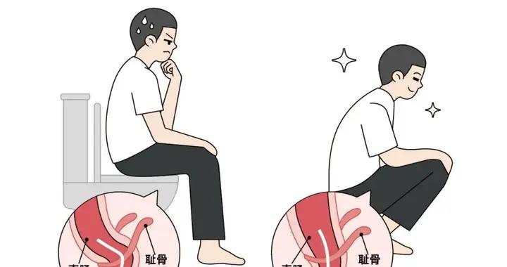拉屎更順暢的 1 種姿勢，很多人卻不知道！