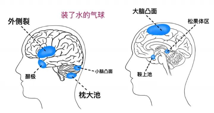 蛛網膜囊腫相關疾病科普知識