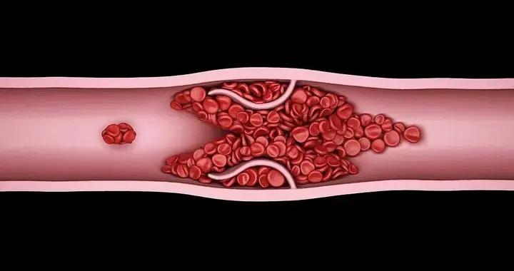 你的血管正在悄悄長斑變硬！這樣做，“斑塊”可能縮小甚至消失