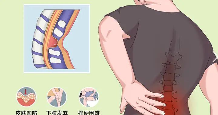 脊柱裂專欄-第36期（隱性脊柱裂科普知識）