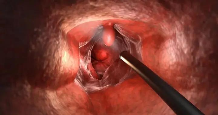 這種能查出癌症的體檢項目，40歲以上的人都要做！